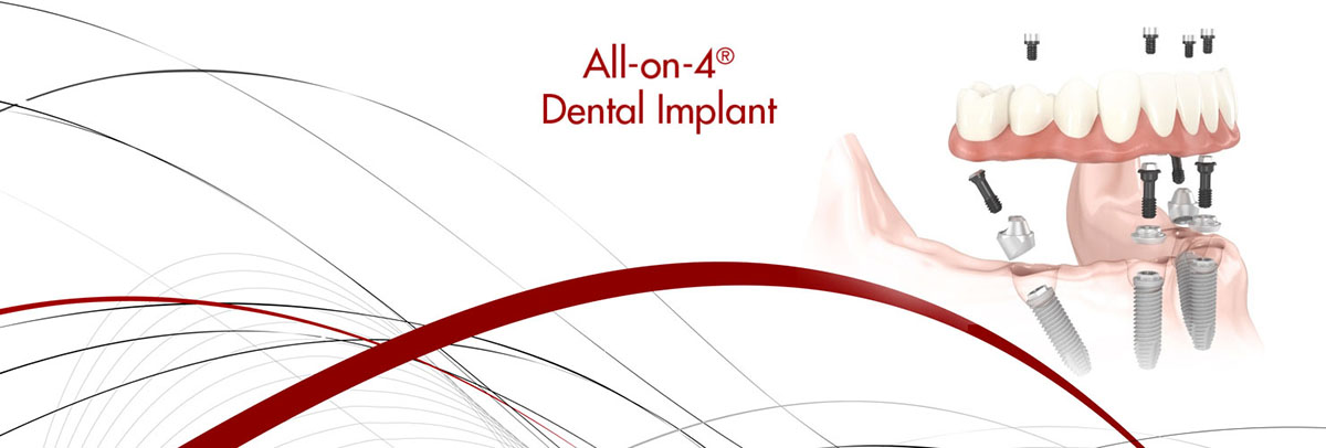Roy All-on-4 Dental Implants