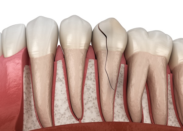 Dental Treatment Options For A Cracked Tooth