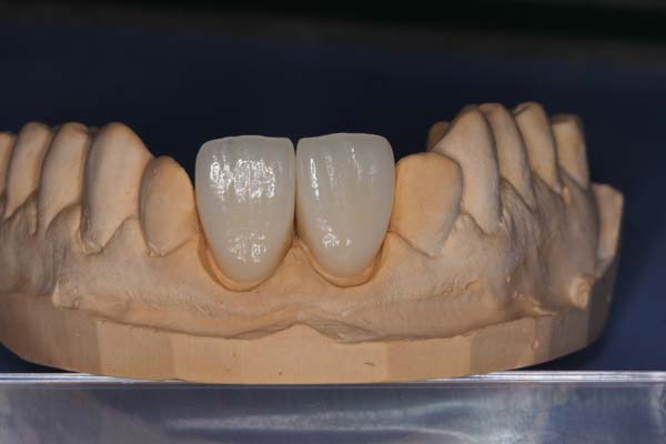 The Number Of Dental Visits For A Dental Crown