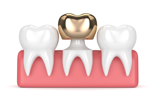 Metal Crowns Vs  Porcelain Dental Crowns