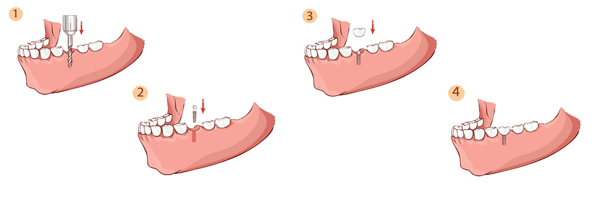 Roy The Dental Implant Procedure