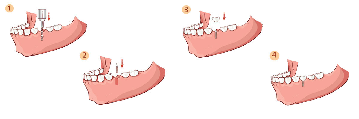 Roy Dental Implant Restoration