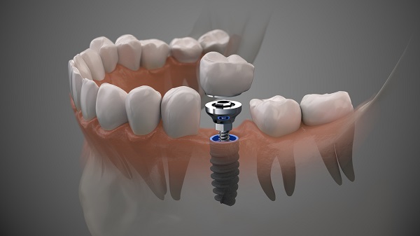 Dental Implants Roy, UT