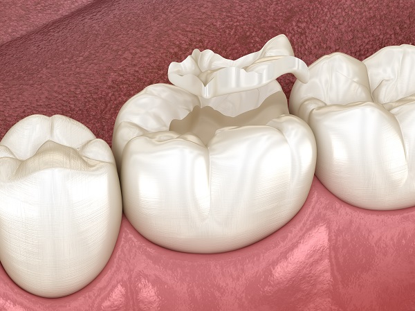 Answers To Questions About Dental Sealants