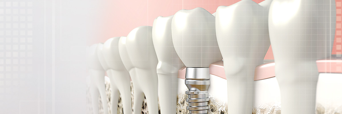 Roy Implant Dentist