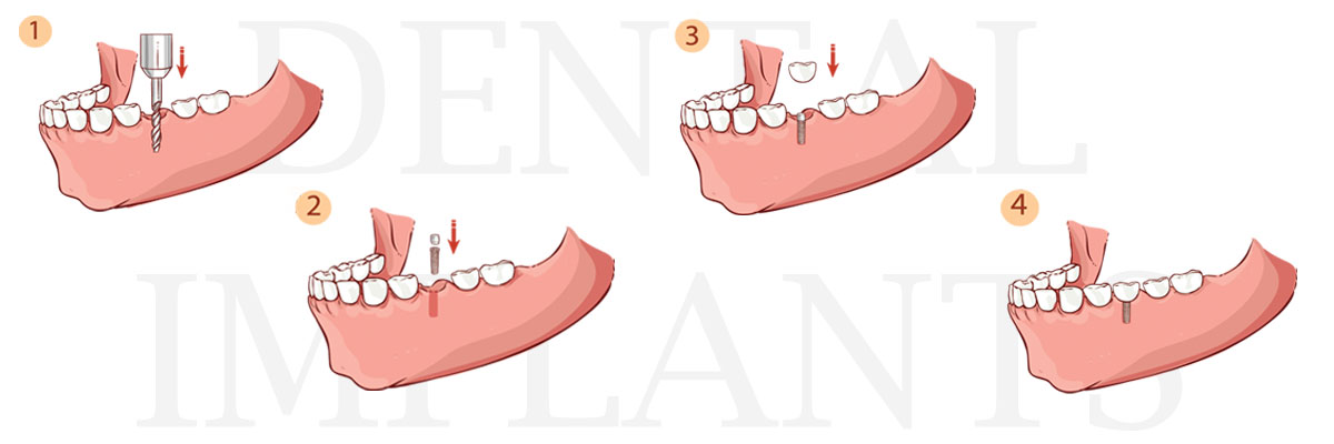 Roy The Difference Between Dental Implants and Mini Dental Implants