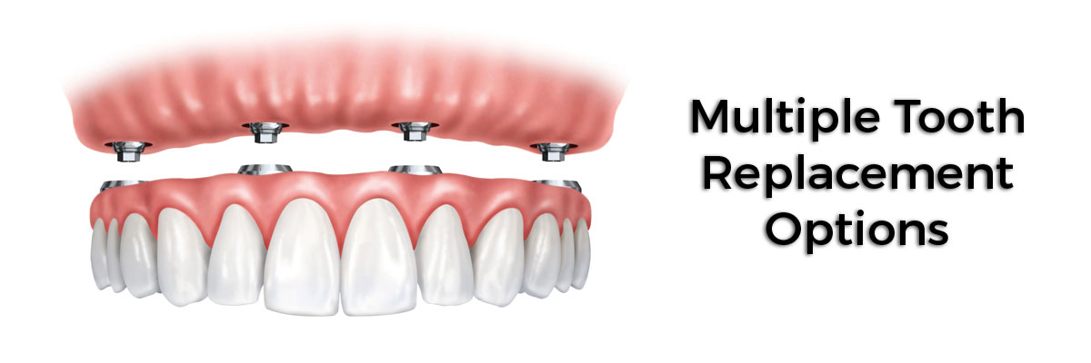 Roy Multiple Teeth Replacement Options