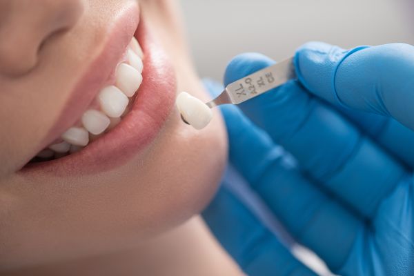 How To Care For Porcelain Veneers