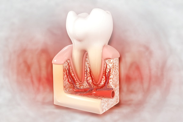 Root Canal Therapy: Protecting The Tooth From Future Infection
