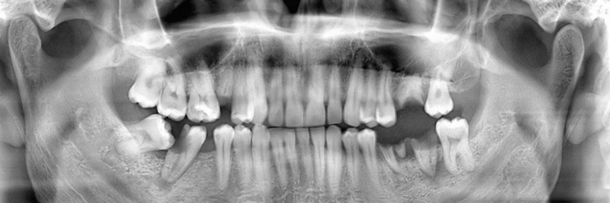 Roy Wisdom Teeth Extraction